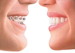 Fort Collins Invisalign vs Braces